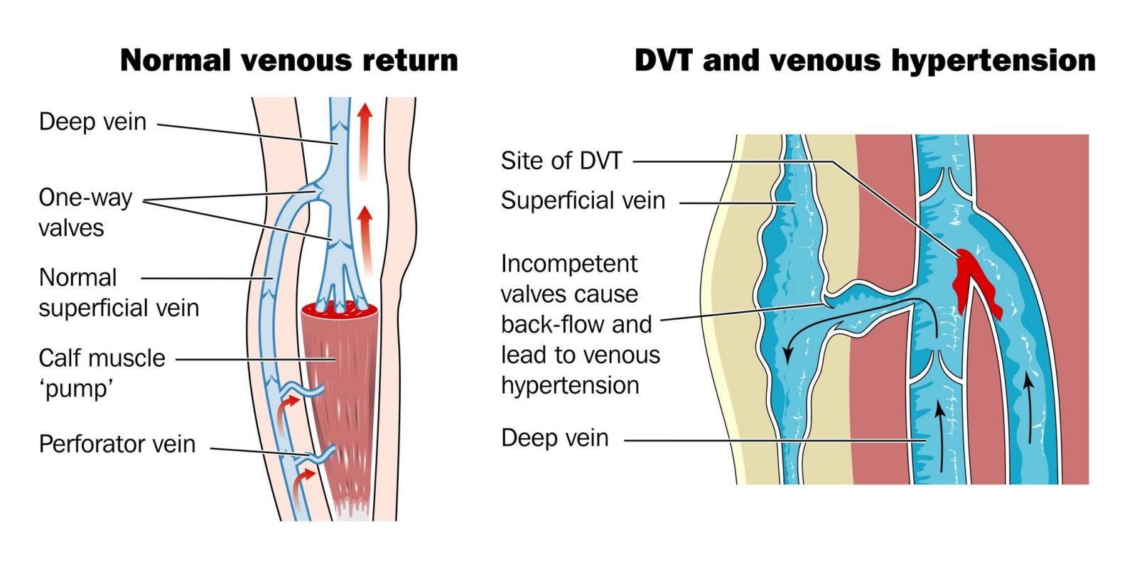 perforator vein thrombosis)