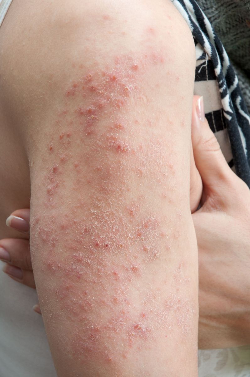 19 Common Foot Disorders - Medscape Drugs Diseases