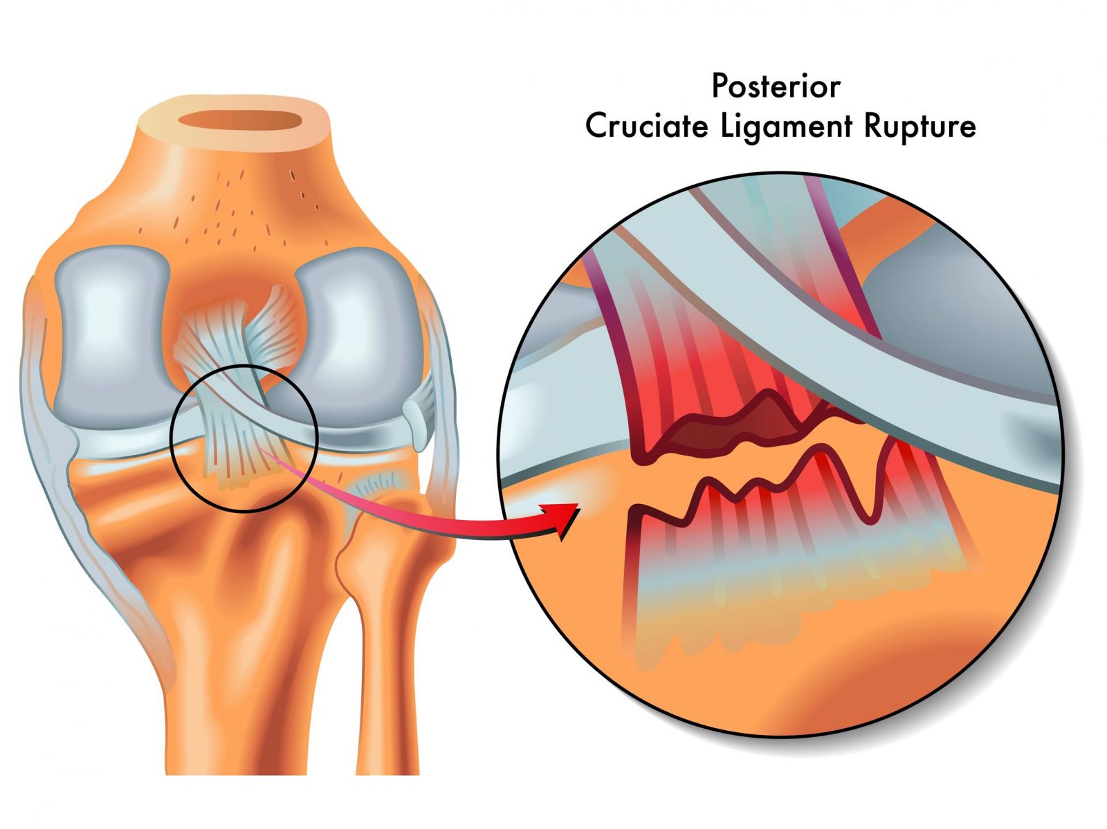 View Ligaments Of The Knee Posterior Pics